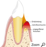 entzündeter Zahn